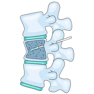 cifoplastia Cirugía de Columna en Cuernavaca