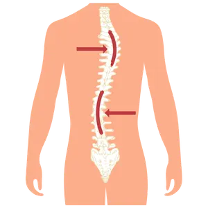 escoliosis Cirugía de Columna en Cuernavaca
