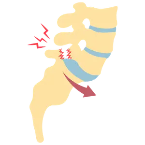 espondilolistesis Cirugía de Columna en Cuernavaca