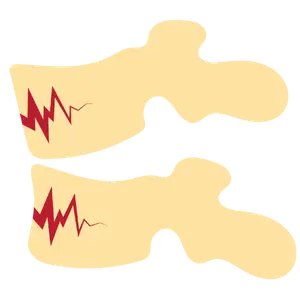 fractura de columna Cirugía de Columna en Cuernavaca