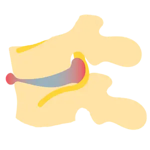 hernia de disco Cirugía de Columna en Cuernavaca