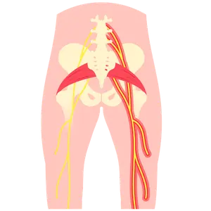 lumbalgia y ciática Cirugía de Columna en Cuernavaca