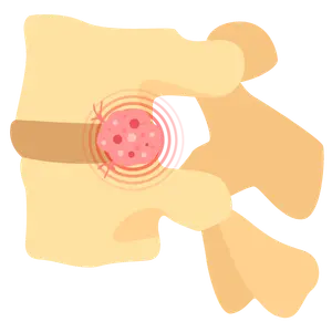 tumores vertebrales Cirugía de Columna en Cuernavaca