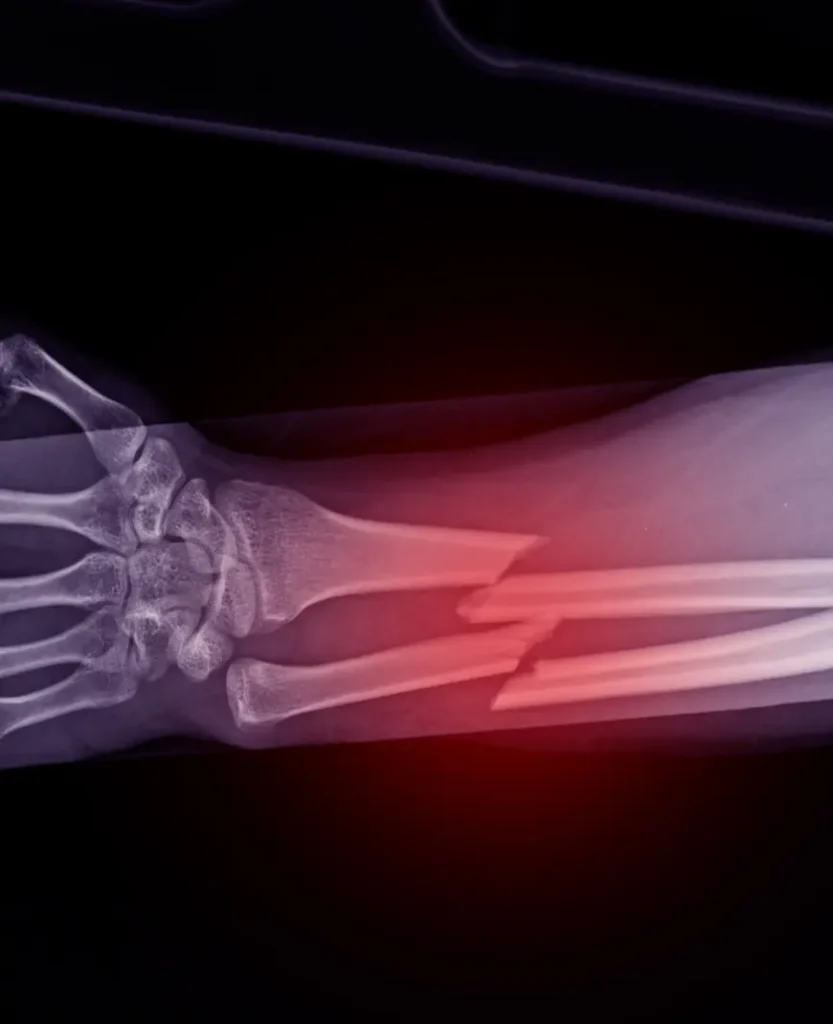 doctor para fracturas y luxaciones