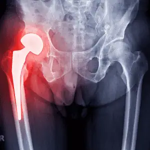 prótesis de cadera prótesis de cadera